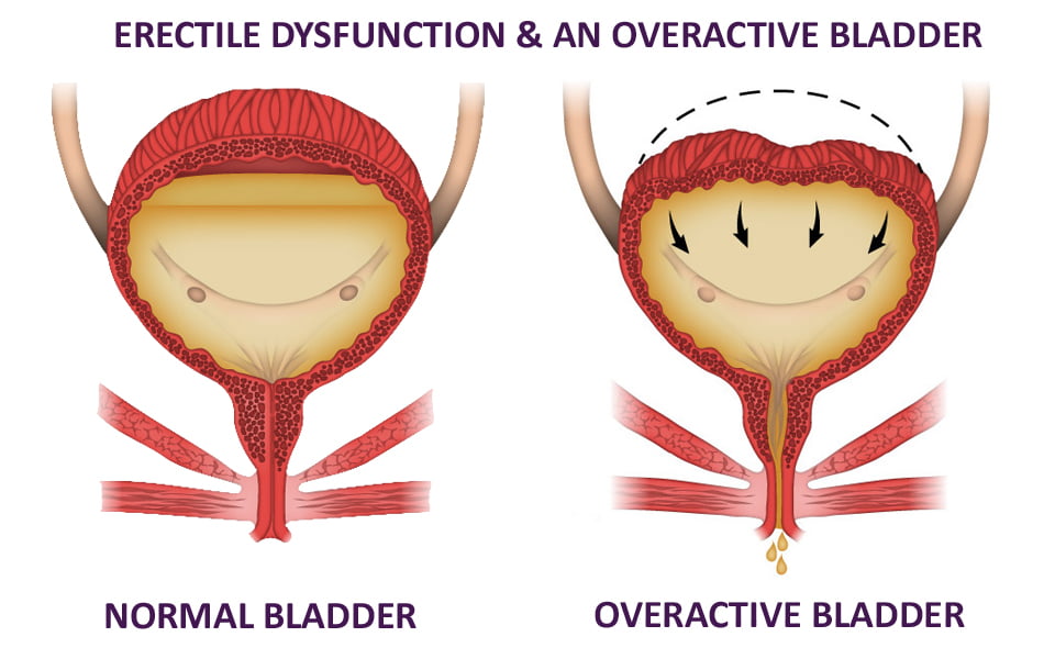 Erectile Dysfunction and an Overactive Bladder.