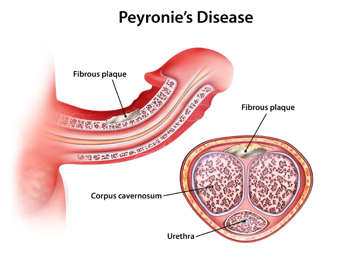 Cross section Peyronie's disease