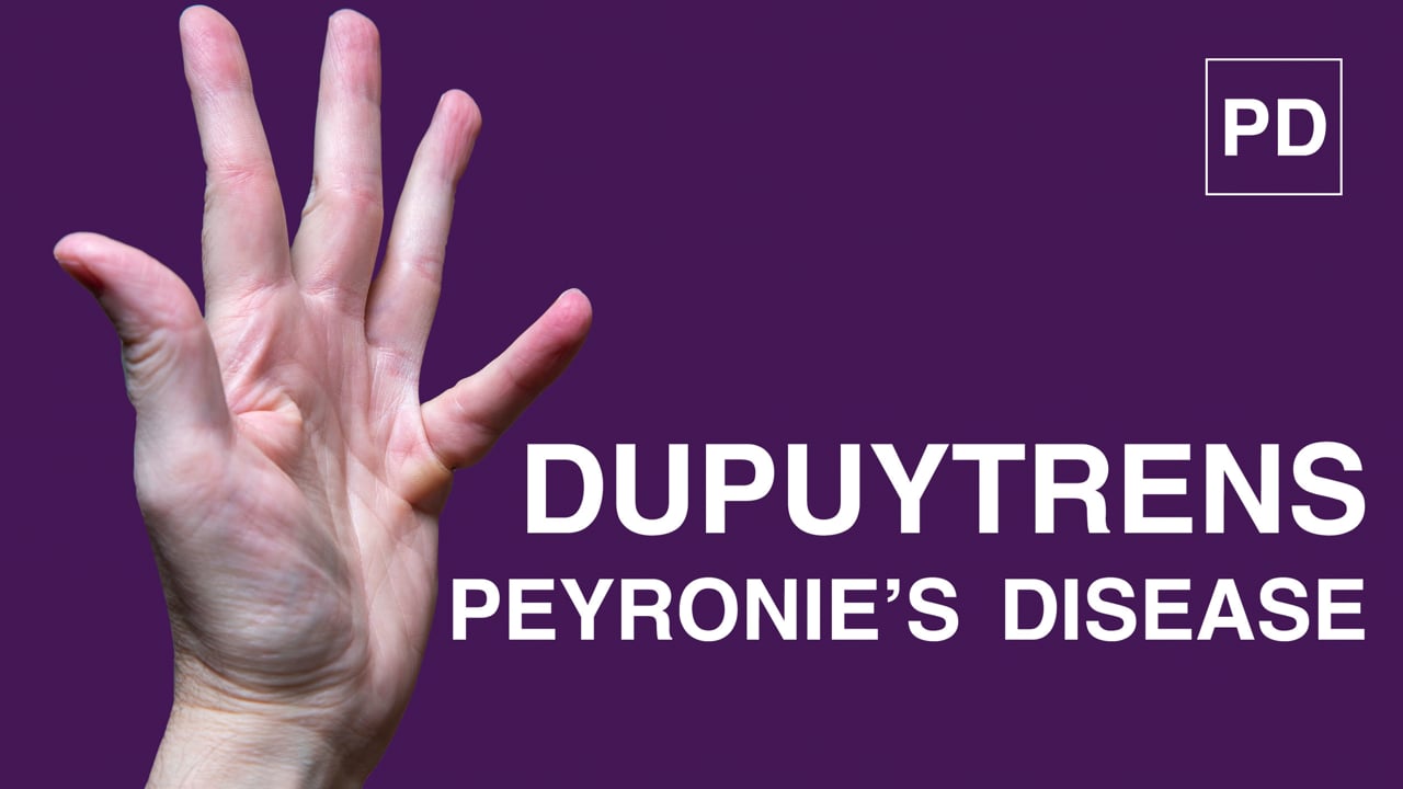 Dupuytren’s Contracture and Peyronie’s Disease