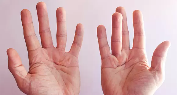 Dupuytren's Disease and Peyronie's Disease