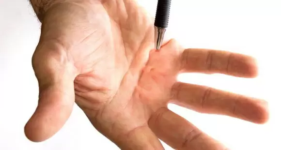 Dupuytren's Disease and Peyronie's Disease