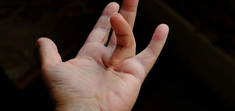 Dupuytren's Disease and Peyronie's Disease