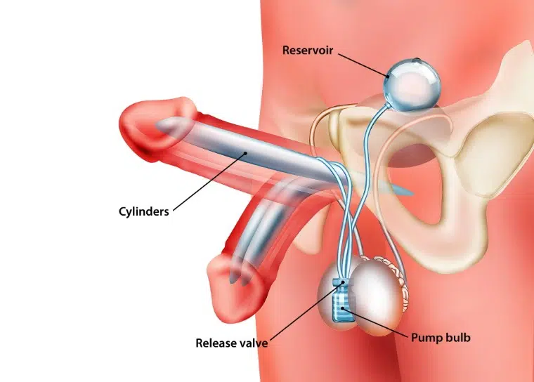 illustration Cross section of peyronies