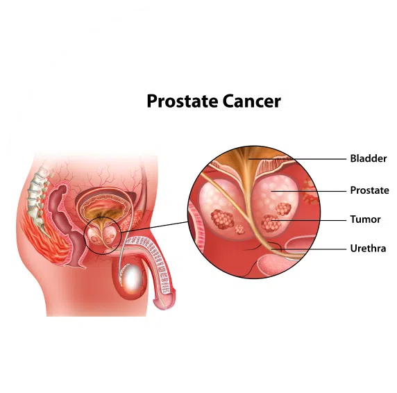 Post Surgery ED Therapy for Prostate Cancer Patients