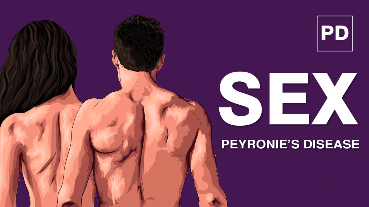 Sex and Peyronie’s Disease