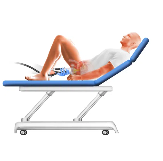 chronic pelvic pain syndrome