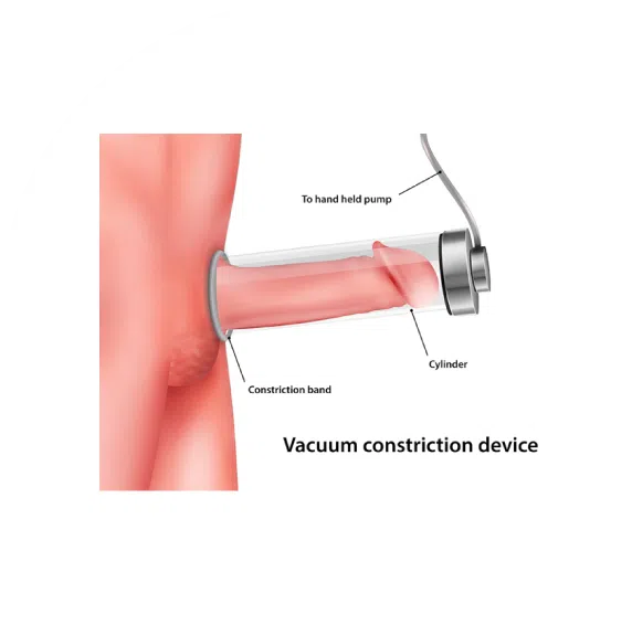 penis vacuum pump