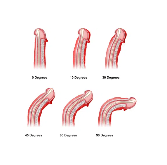 peyronie's disease treatment london