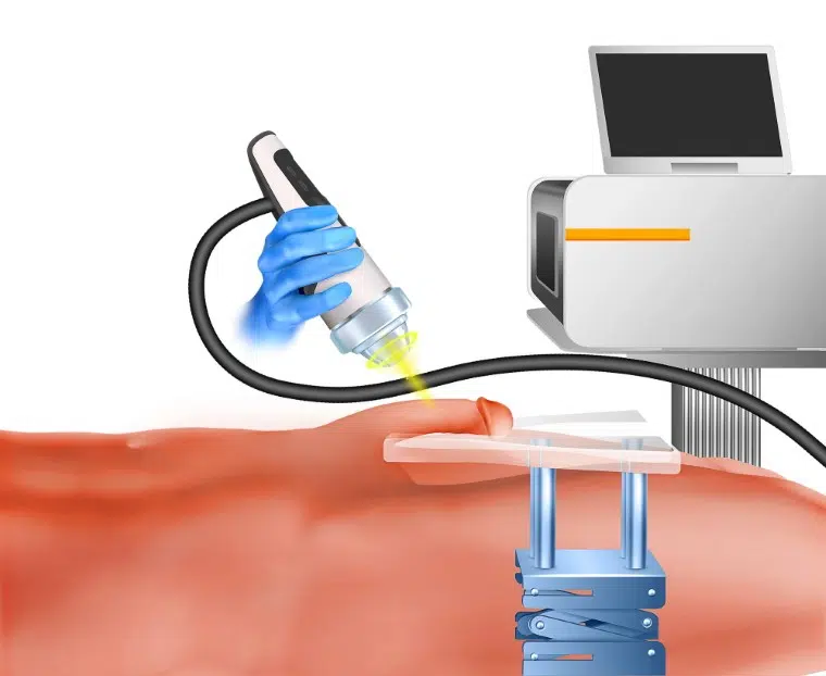 shockwave therapy for erectile dysfunction