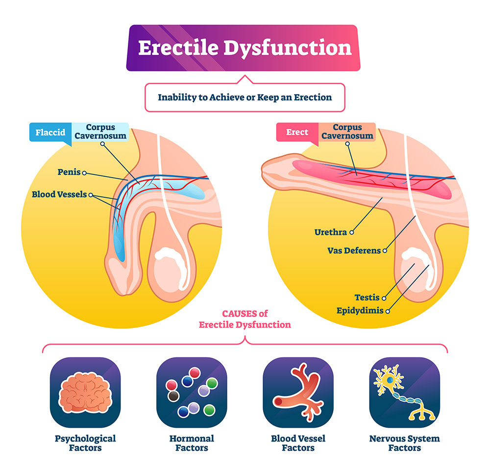 Erectile dysfunction causes, men’s health, treatment options for ED