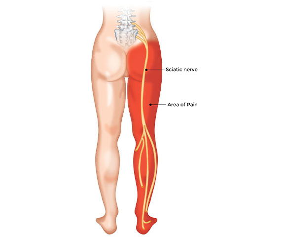 Sciatica & Erectile Dysfunction – Understanding Nerve-Related ED