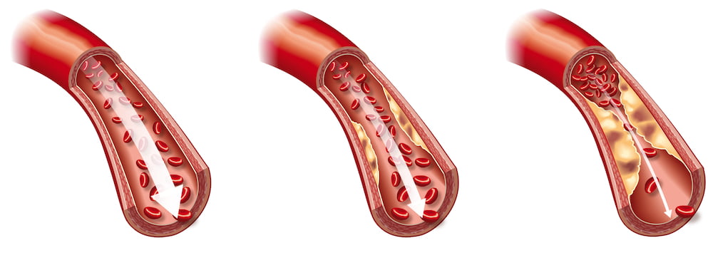 Erectile Dysfunction Treatment London Erectile Dysfunction High Cholesterol