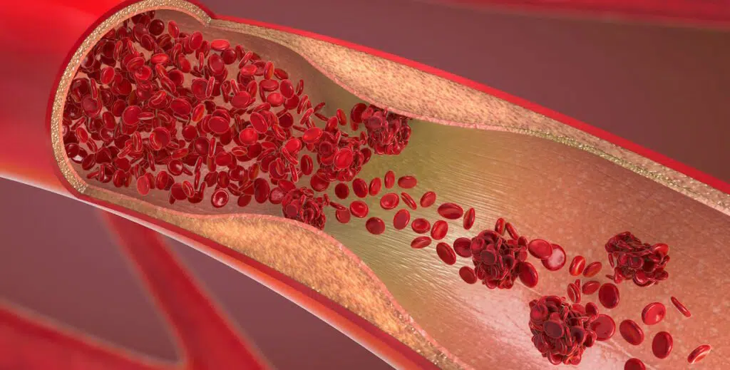 Erectile Dysfunction Treatment London Vasculogenic Erectile Dysfunction – Causes & Vascular Solutions