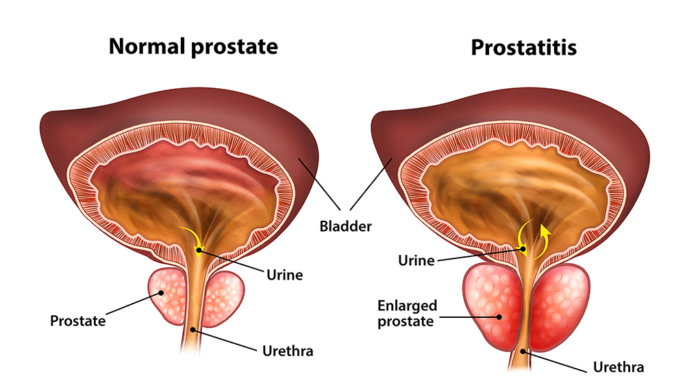 can an enlarged prostate cause erectile dysfunction, prostate enlargement, urinary symptoms, sexual health