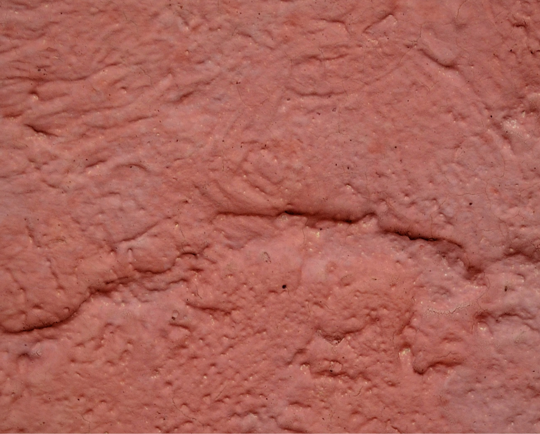 Close-up view of scarred and inflamed tissue with an uneven, fibrous texture, illustrating plaque formation associated with Peyronie’s disease.